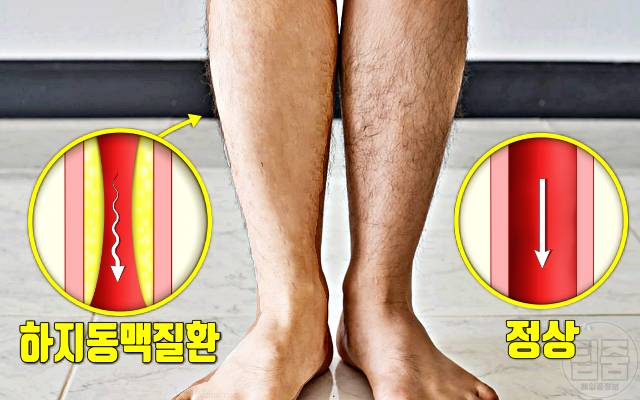 걸을때 종아리가 아파요 하지동맥질환 증상 다리털 발톱