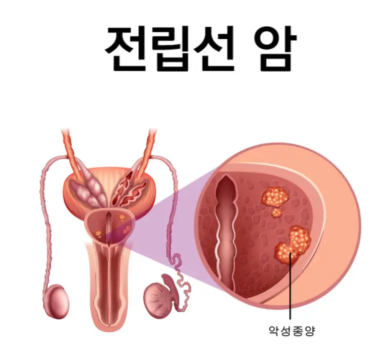 전립선암