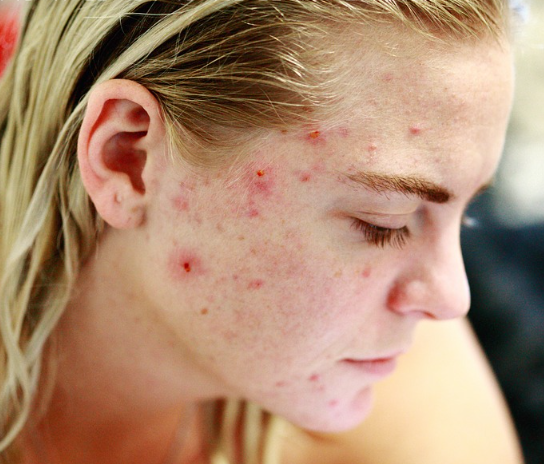 기미없애는방법