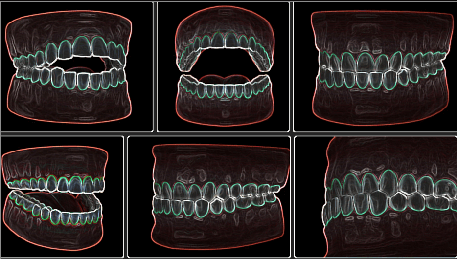 부정교합과 턱관절 장애의 상관관계