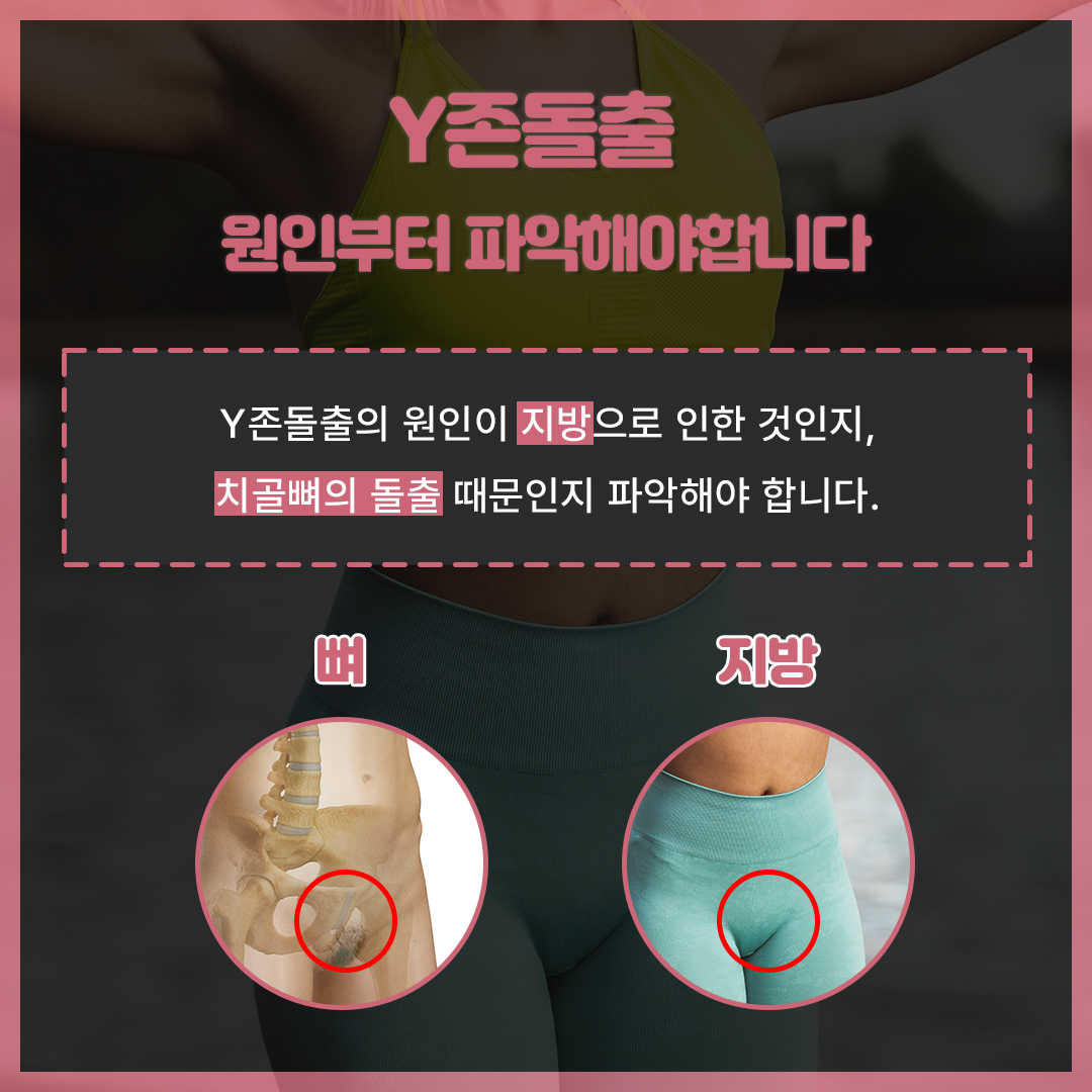 Y존
Y존 케어
Y존 부각 원인