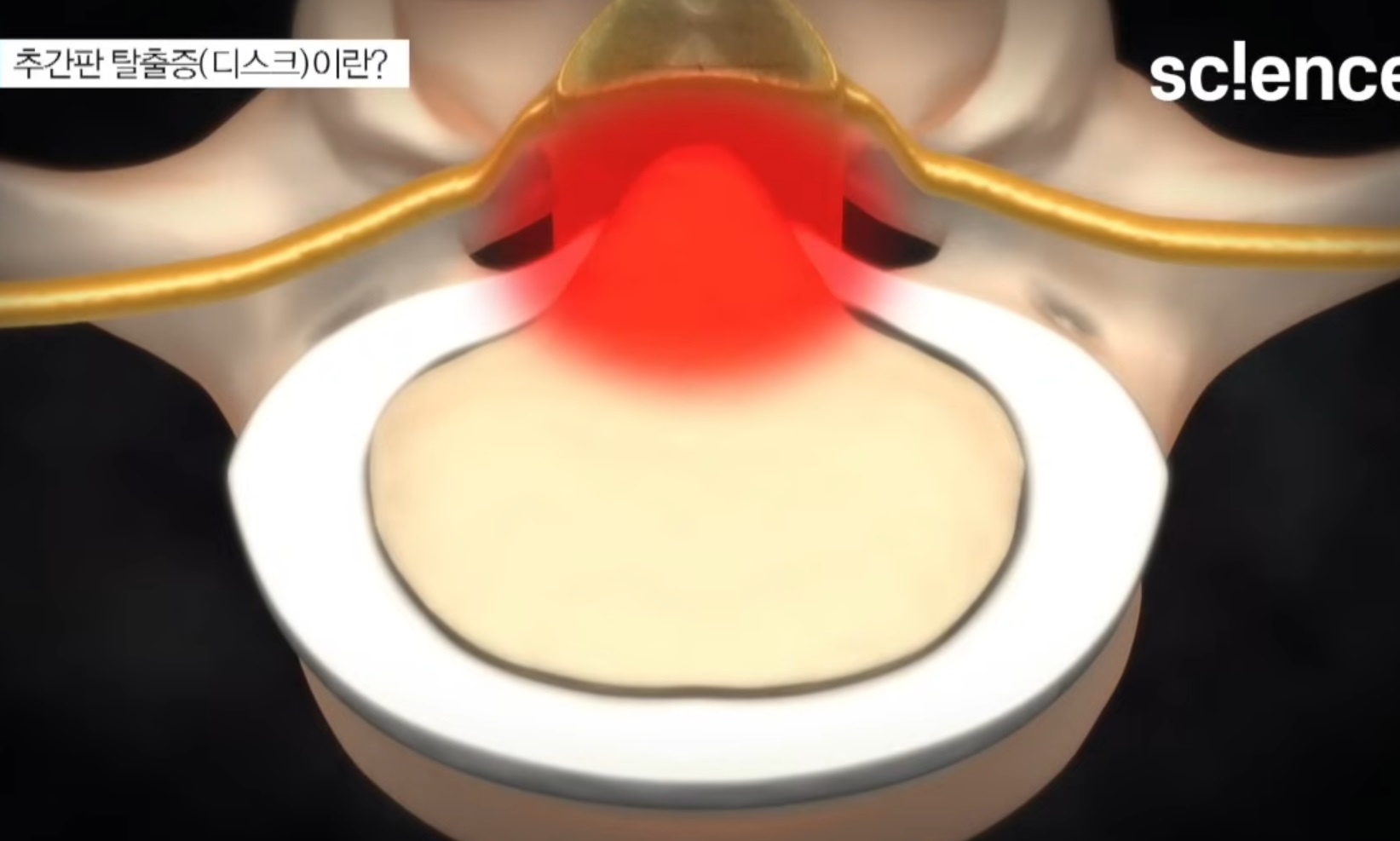 허리디스크-명의-진동규-교수