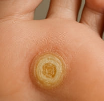 티눈 없애는 방법