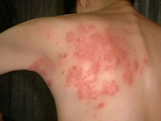 대상포진 예방접종 무료대상ㅣ초기증상 부작용