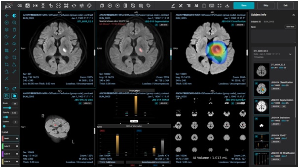 뇌졸중 예방 전략 관련 이미지