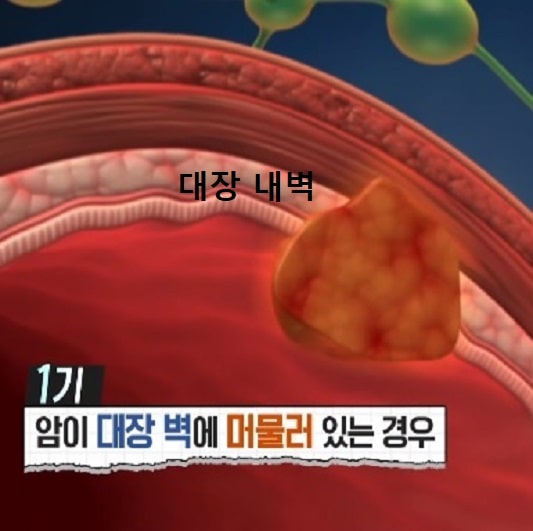 대장암 증상