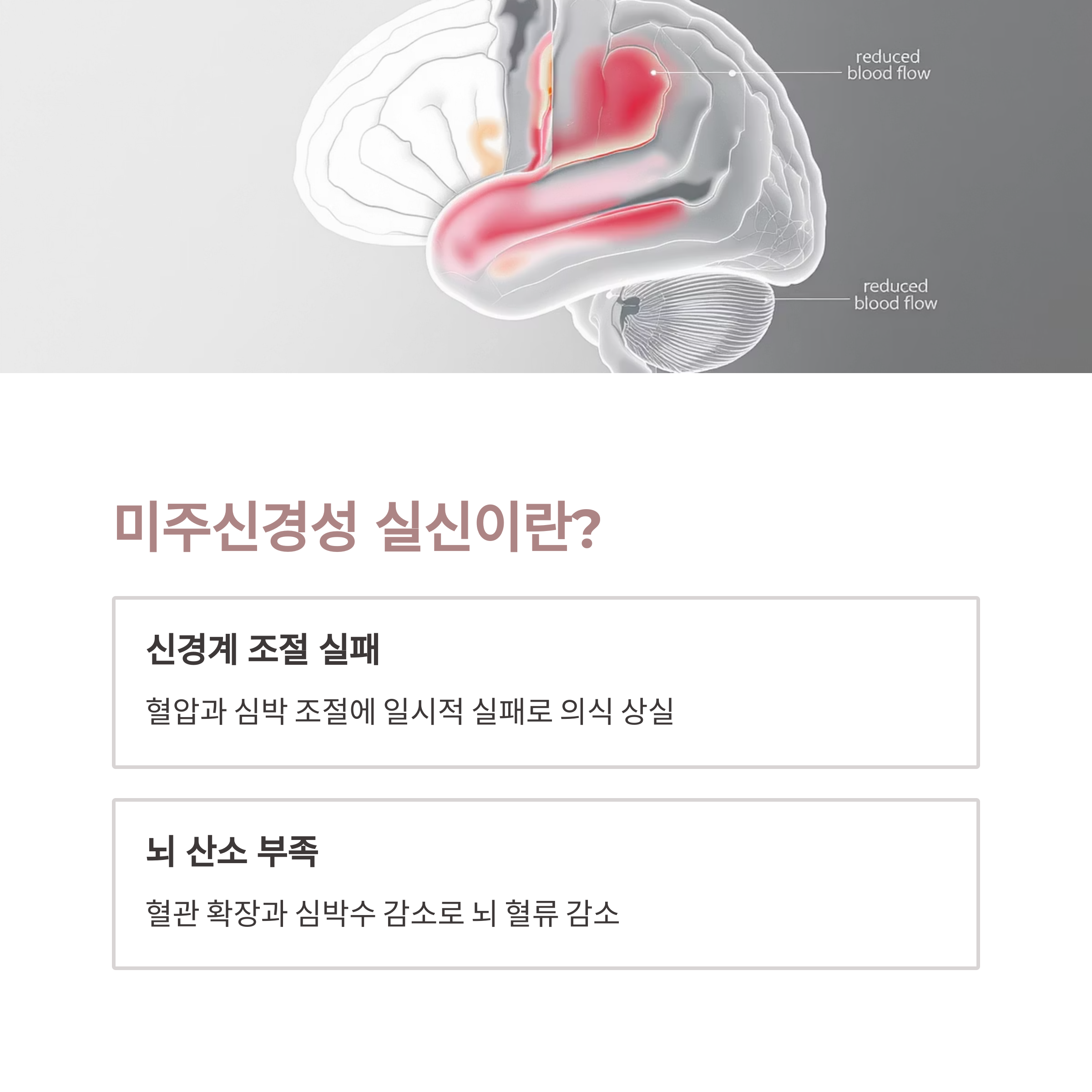 뇌 혈류 감소를 시각적으로 표현한 이미지와 함께, 미주신경성 실신의 원인으로 신경계 조절 실패 및 뇌 산소 부족을 설명한 인포그래픽