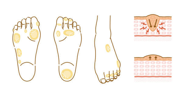 발바닥 티눈 없애는법 완벽 꿀팁! 원인부터 재발 방지까지