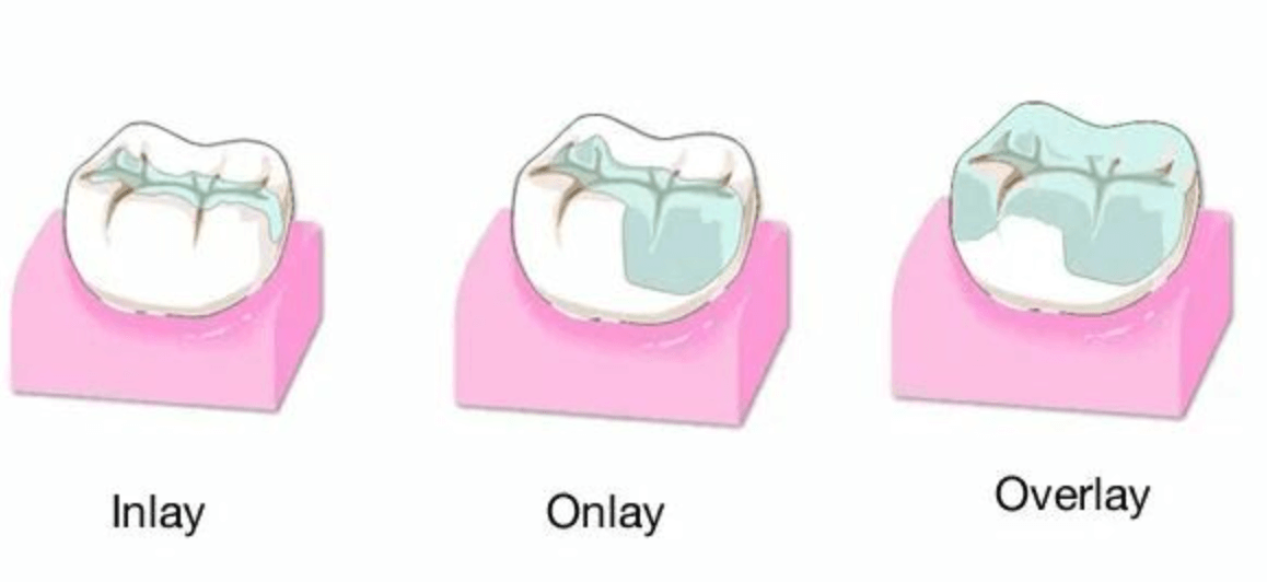 충치 치료 비용