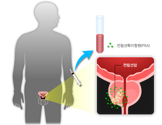 전립선 비대증 치료