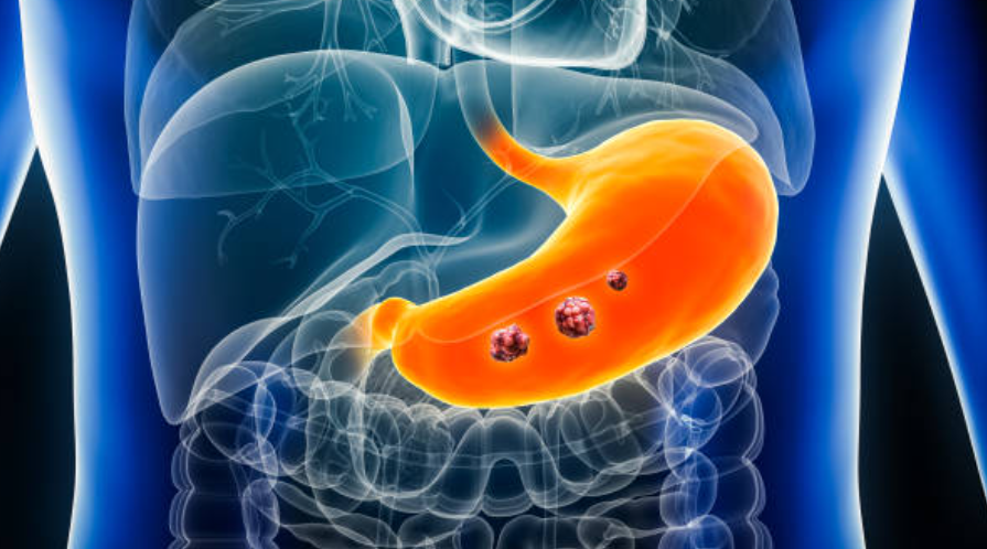 위암과 관련된 사진2