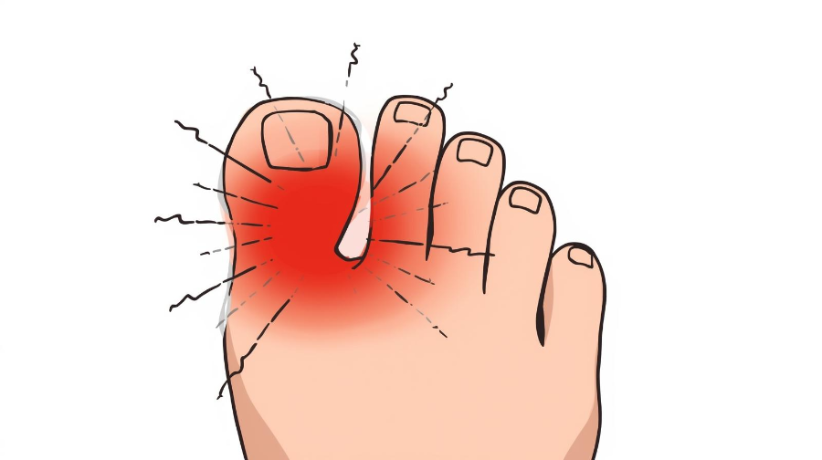 발가락 관절이 붓고 붉게 변한 통풍 초기 증상 일러스트
