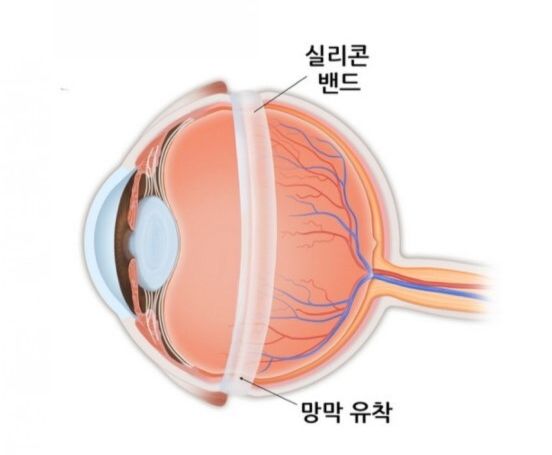 망막박리 증상, 원인, 치료 방법