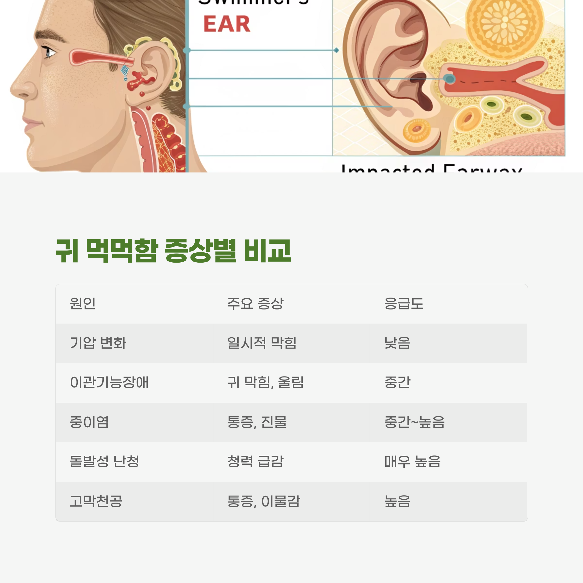귀 먹먹함 증상별 비교 요약
