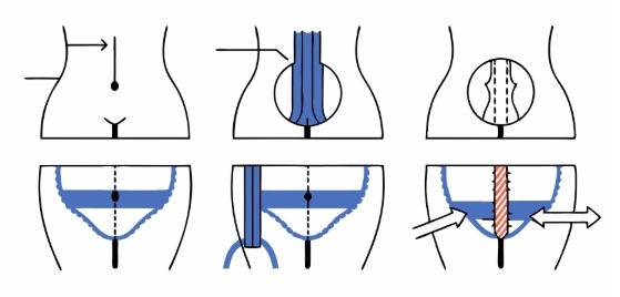 맹장수술전과정