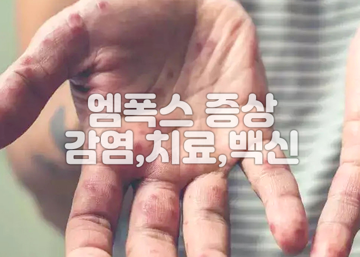 엠폭스로 인한 손의 발진 이미지