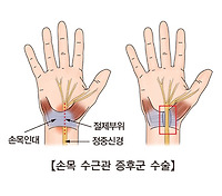 손목터널증후군 증상