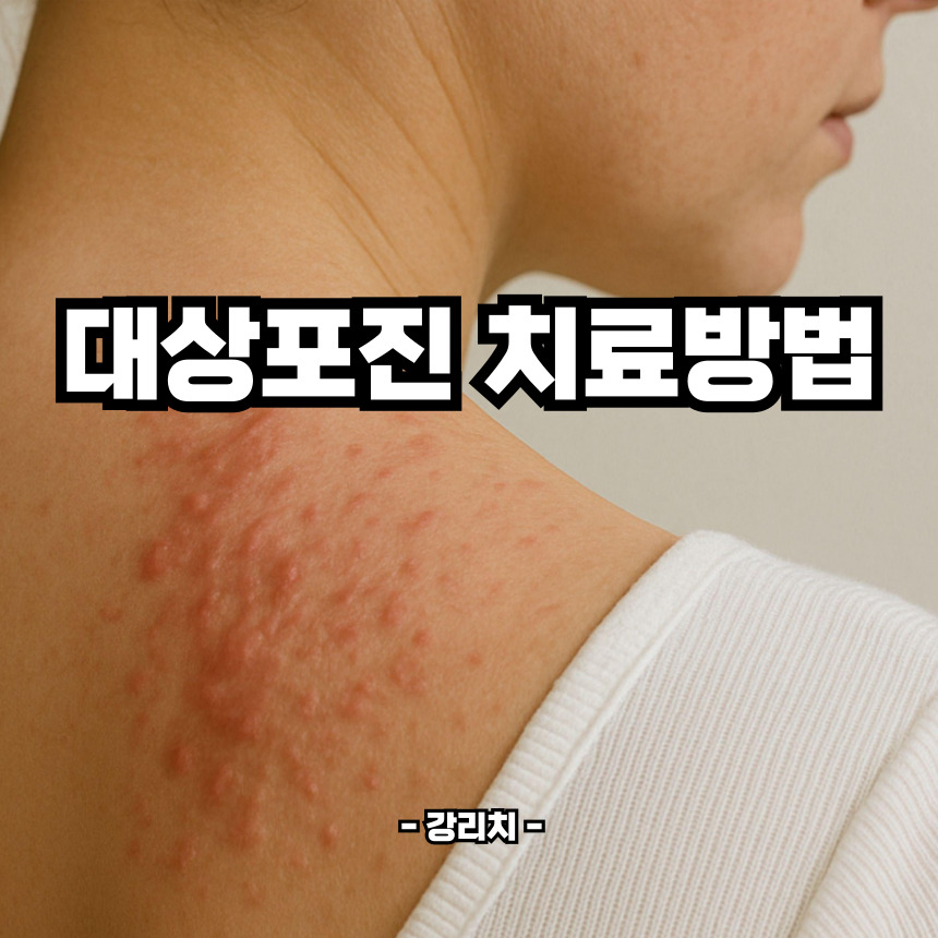 대상포진 치료방법