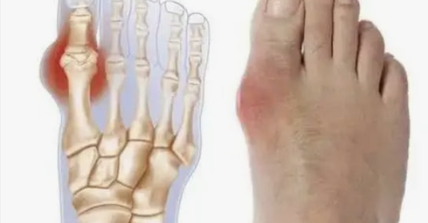 통풍 증상&amp;#44; 이렇게 아플 줄 몰랐어요