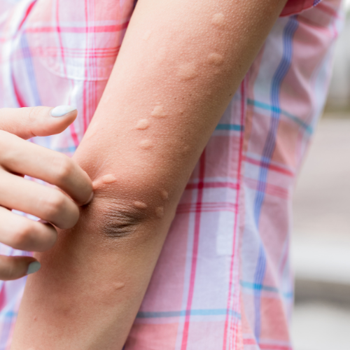 접촉성피부염증상 이게 시작이라니 피부염원인부터 관리법까지