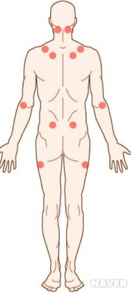 섬유근육통 증상과 치료법 총정리 만성 통증 잡는 방법은?