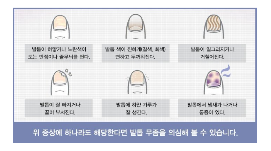 발톱 무좀 증상