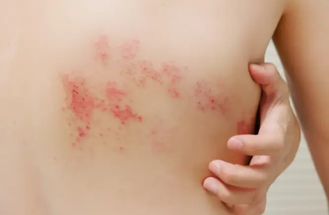 대상포진