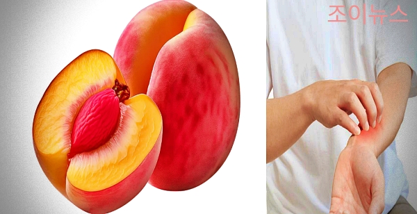 복숭아 식품알레르기 증상