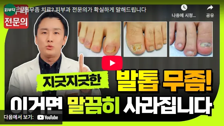 피부과 전문의가 알려주는 발톱 무좀 치료법