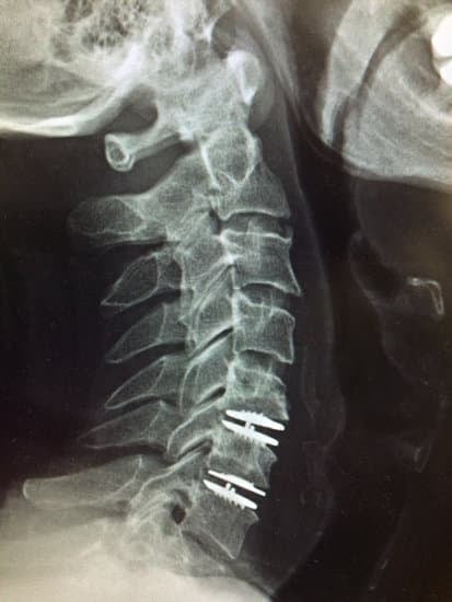 경추 협착증 (Cervical Spinal Stenosis): 원인, 증상, 치료법 총정리