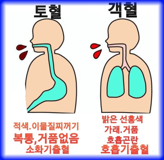 호흡기 질환: 객혈- 종류, 원인, 증상, 진단방법, 치료방법.