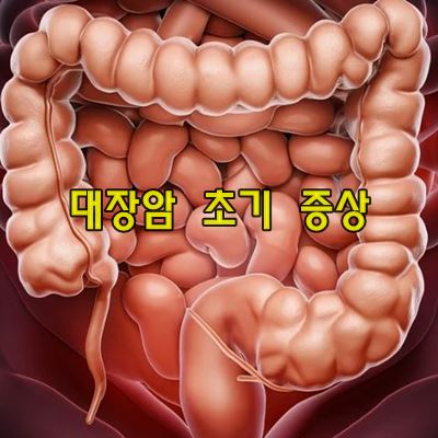 대장암 초기 증상