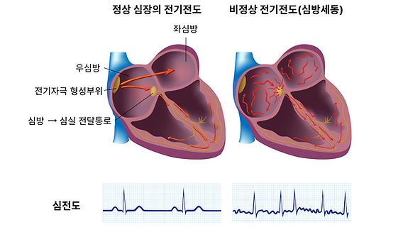 부정맥 증상