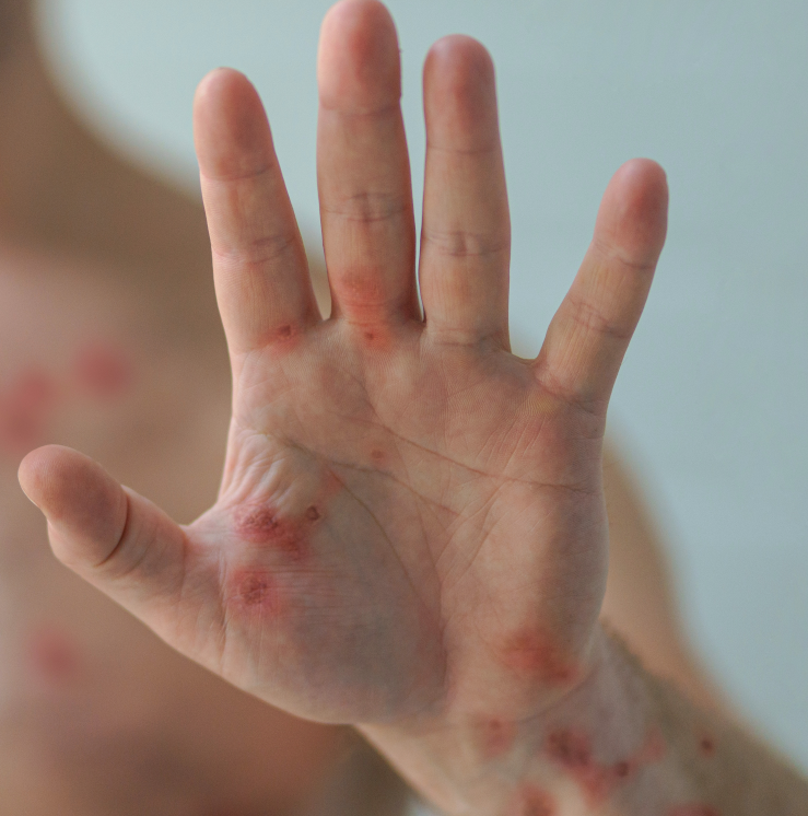 엠폭스 증상과 엠폭스 원인