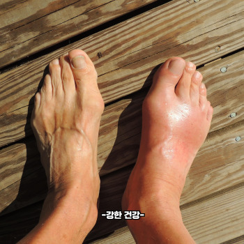 통풍 증상