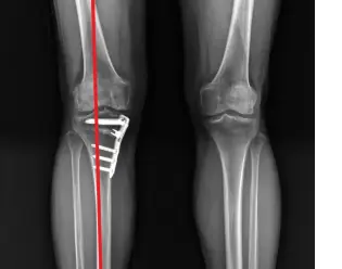 근위경골절골술 시행한 뼈 사진