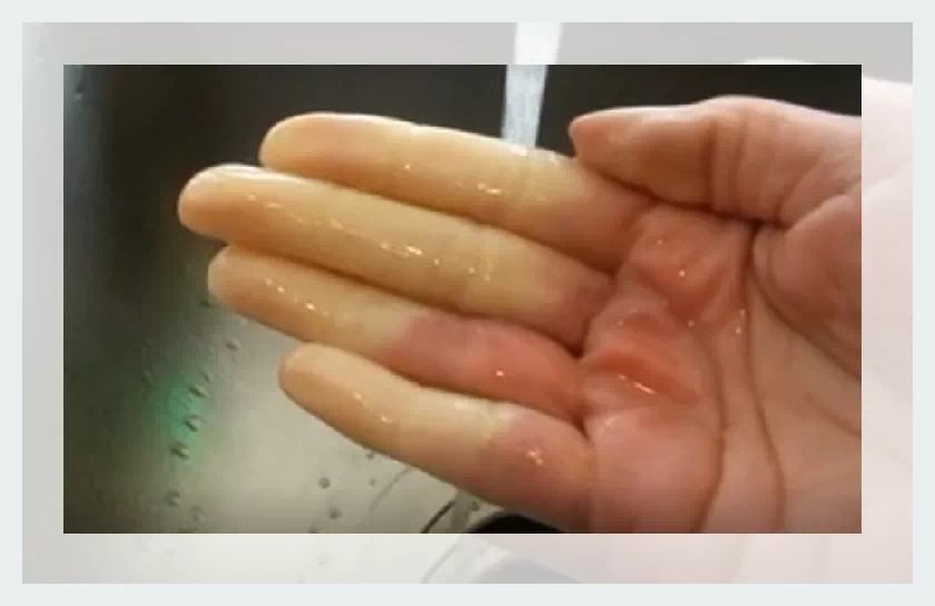 손 레이노이드증후군