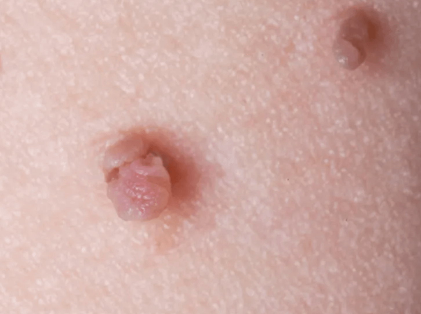 쥐젖 제거 후기