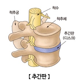 추간판 탈출증