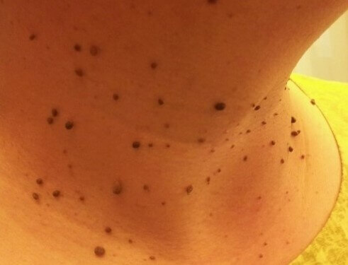 목에 있는 쥐젖