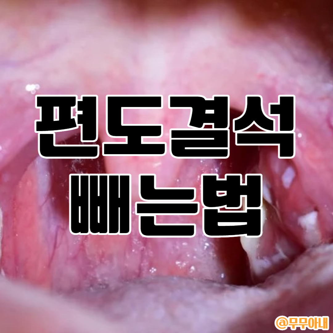 편도결석