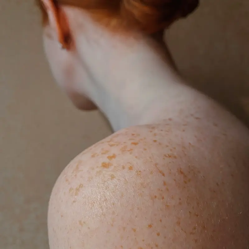 중년 여성 피부장벽 무너질 때 생기는 기미·잡티, 이렇게 회복하세요