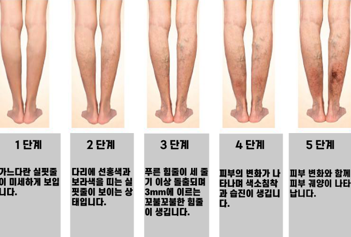 하지정맥 단계입니다