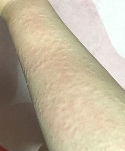 팔 좁쌀 두드러기