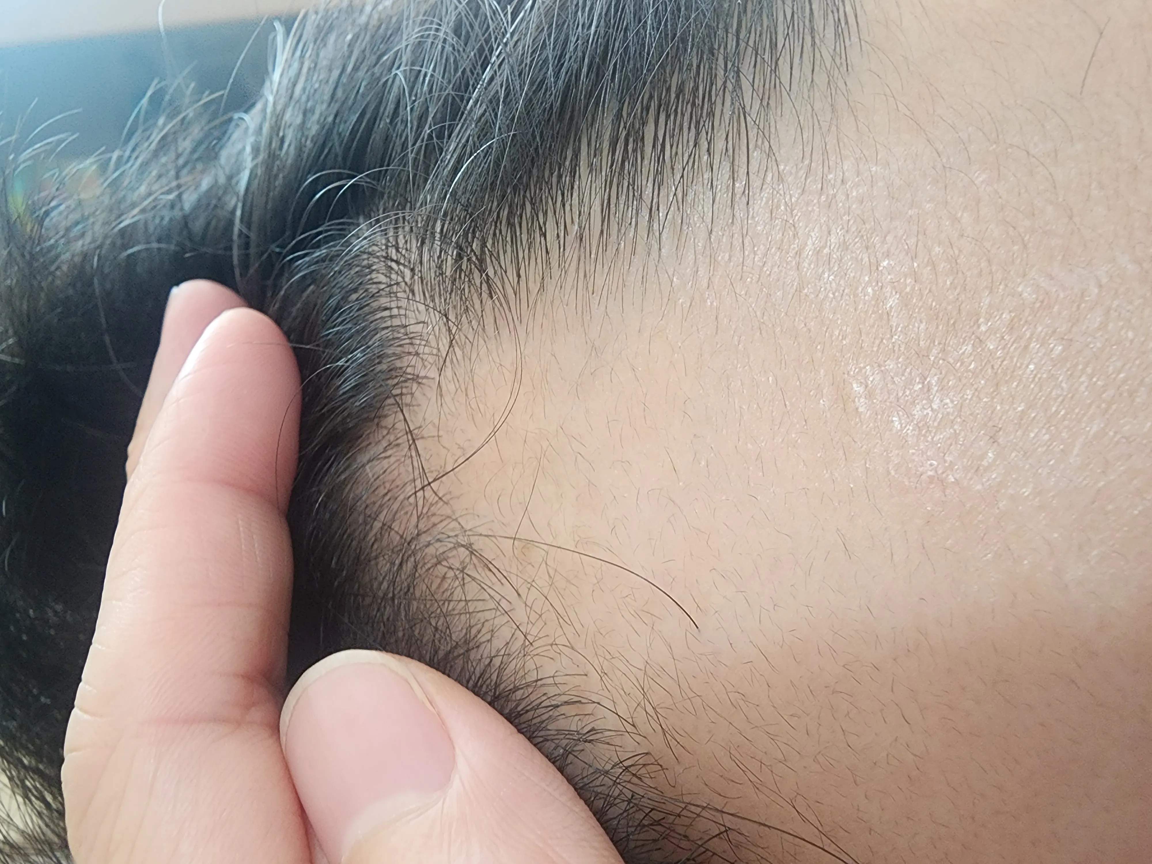 피나스로 먹고3개월뒤 잔털이 올라옴