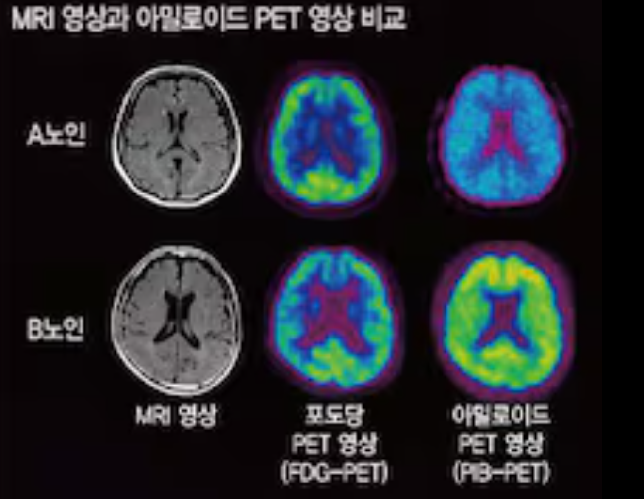 독감 백신과 치매 위험 감소 연관성 연구 관련 이미지