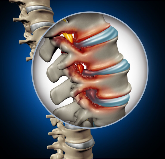 척추 협착증 이미지