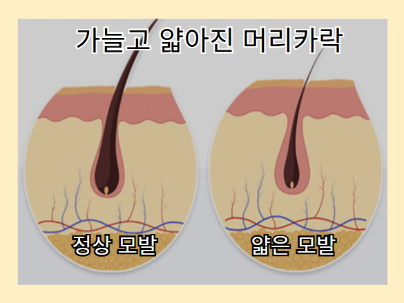 탈모 증상 - 가늘고 얇아진 머리카락
