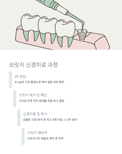 브릿지 신경치료 과정