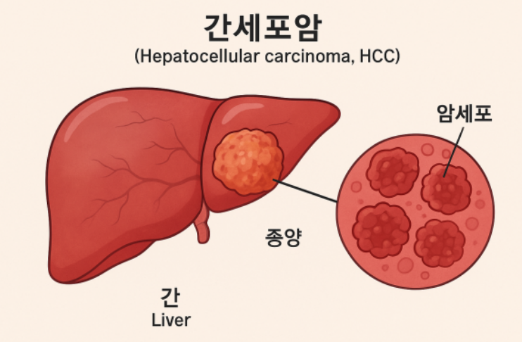 간암세포